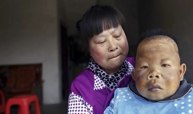 ชายชาวจีนป่วยประหลาด…อายุ 30 ปี แต่กลับมีร่างกายและสติปัญญาเท่าเด็กหัดเดิน